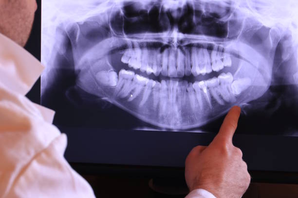 Best Dentist for Tooth Abscess  in Iota, LA